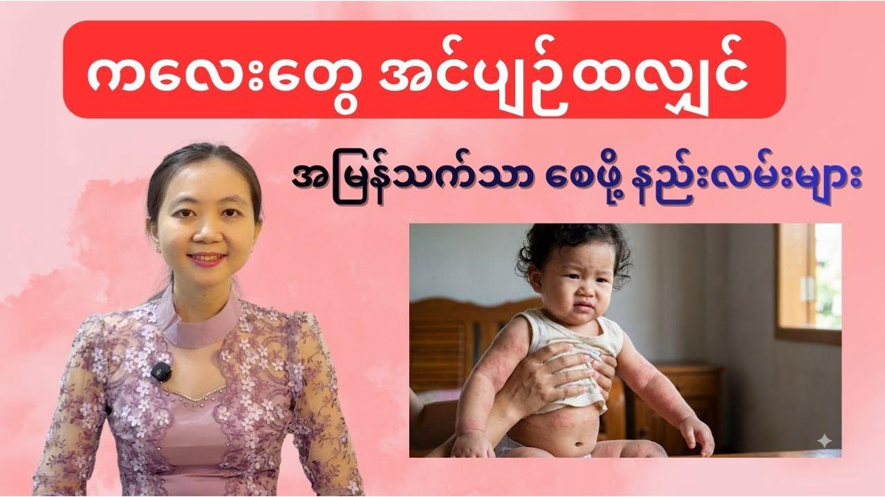 ကလေးတွေ အင်ပျဉ်ထလျှင် အမြန်သက်သာစေဖို့ နည်းလမ်းများ | Urticaria rash | By Dr. Lwin