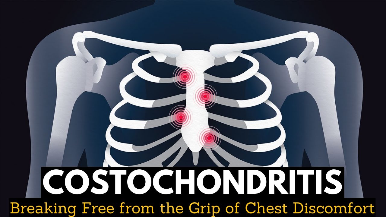 Costochondritis: Breaking Free from the Grip of Chest Discomfort