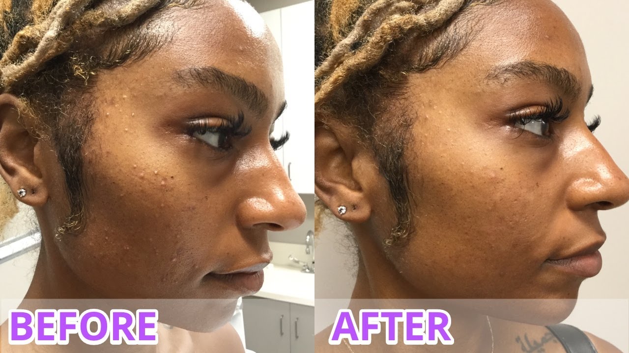 VLOG: Mask Acne is REAL! Trying the Diamond Glow Facial to Instantly Help Congestion| iamLindaElaine