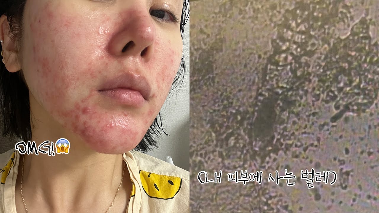 드디어 모낭충 검사🪳😱 내 주사피부염의 원인은 뭘까?🤔❓