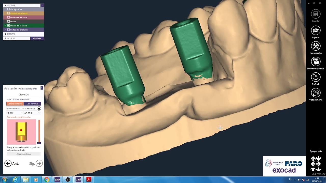 Exocad Dental Cad Corona Sobre Implante 13 y  Puente Sobre implantes 24 a 26 atornillados.
