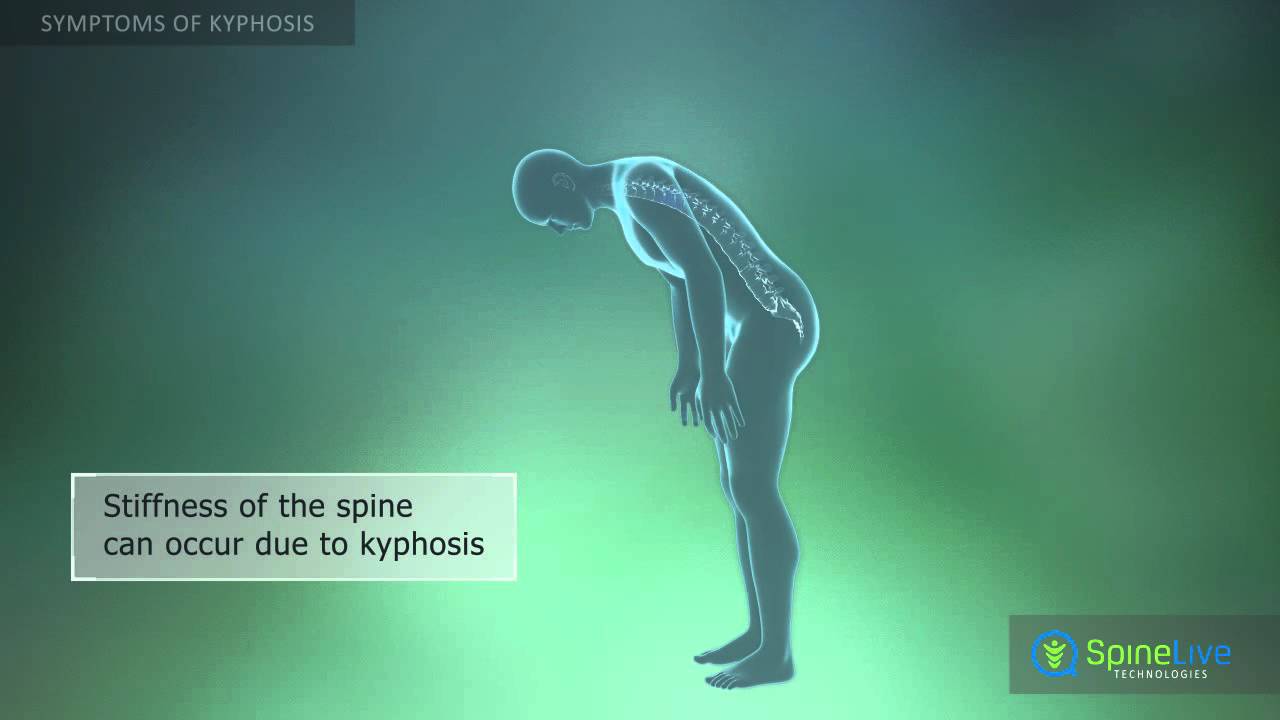 Kyphosis Symptoms