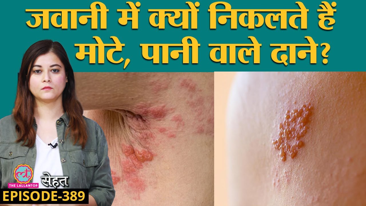 बचपन में Chicken Pox हो चुका है तो ज़रा दर्दनाक Shingles से बचकर रहें | Sehat ep 389