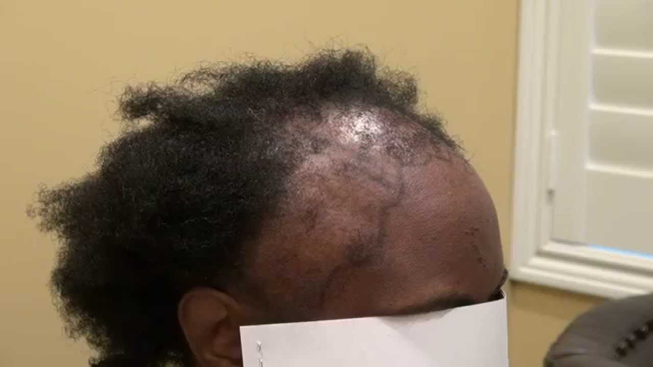 Black Woman Hair Transplant Advanced Hair Loss Pattern Surgery Dr. Diep www.mhtaclinic.com