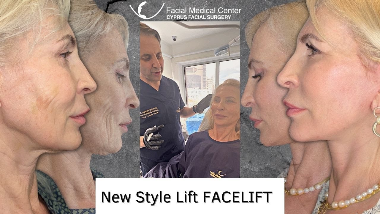 New Style Lift FACELIFT |Cyprus Facial Surgery