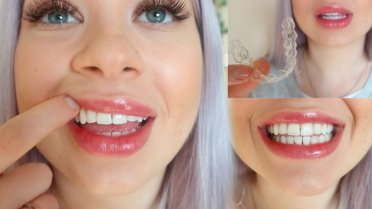Invisalign update I Tips & Tricks I Moriah Shae