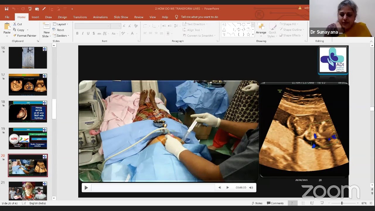 Fetal Interventions  - How do we transform lives & 11-13 weeks scan