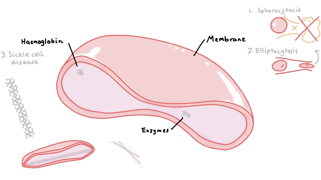 7 Types of Haemolytic Anaemia