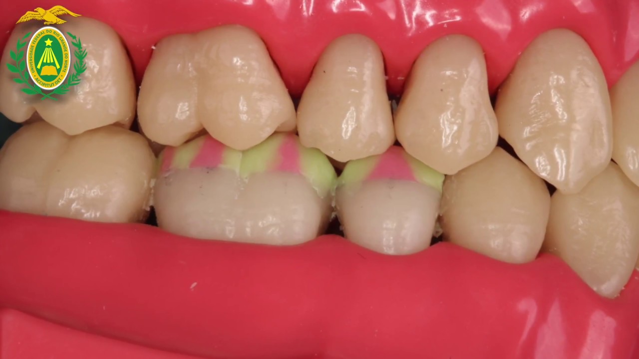 Enceramento - Vertente externa e perímetro oclusal