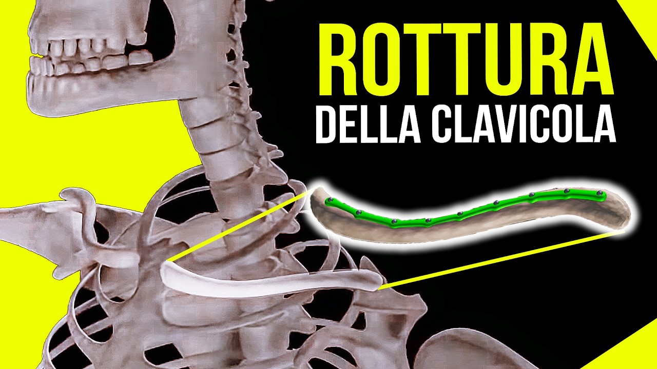 DISASTRO alla CLAVICOLA ⚠️ : l'INCREDIBILE INGEGNERIA BIOMEDICA!