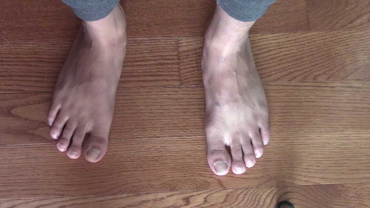 Fallen Arch Treated by Mobilizing the Subtalar Joint