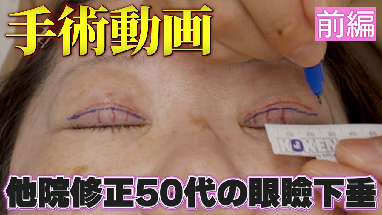 【前編】50代の眼瞼下垂デザイン解説ほぼノーカット手術動画│デザイン解説