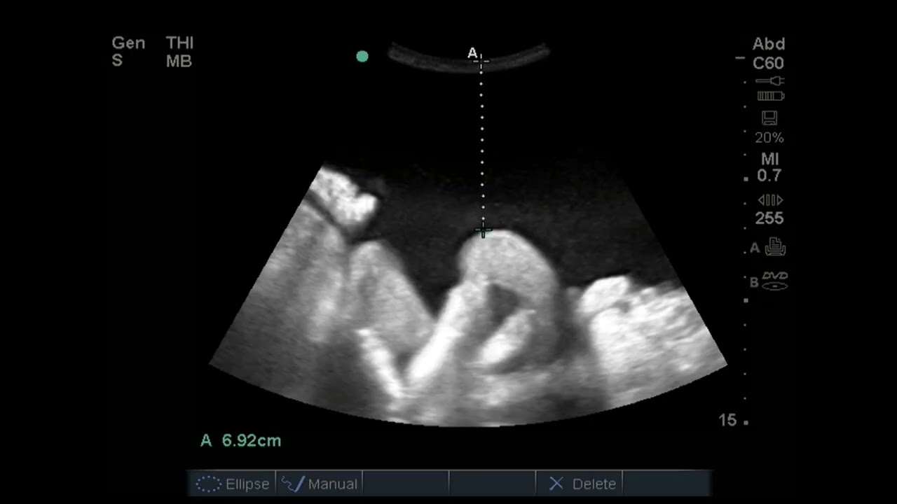 Ultrasound-Guided Procedures for Family and Internal Medicine-Sample