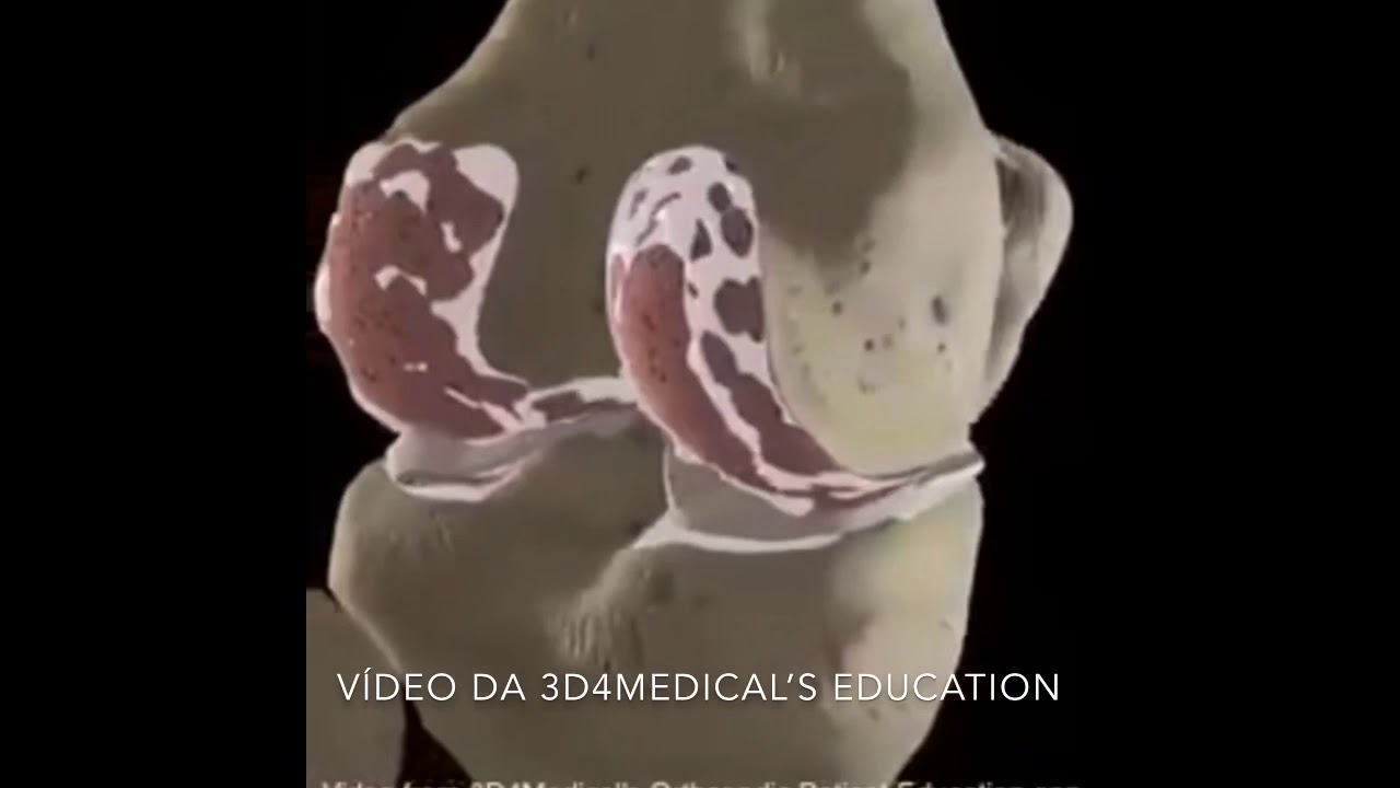 Animação da cirurgia de artroplastia total de joelho. Dr Douglas Pavão
