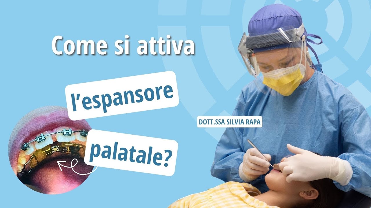 Tutorial video a supporto dei pazienti:  attivazione dell’ espansore palatale rapido