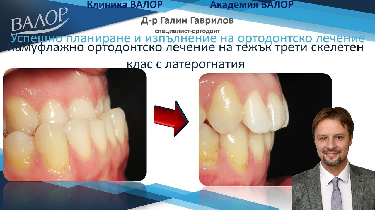Камуфлажно лечение на тежък трети скелетен клас с латерогнатия. #ортодонтия #ортодонт #брекети
