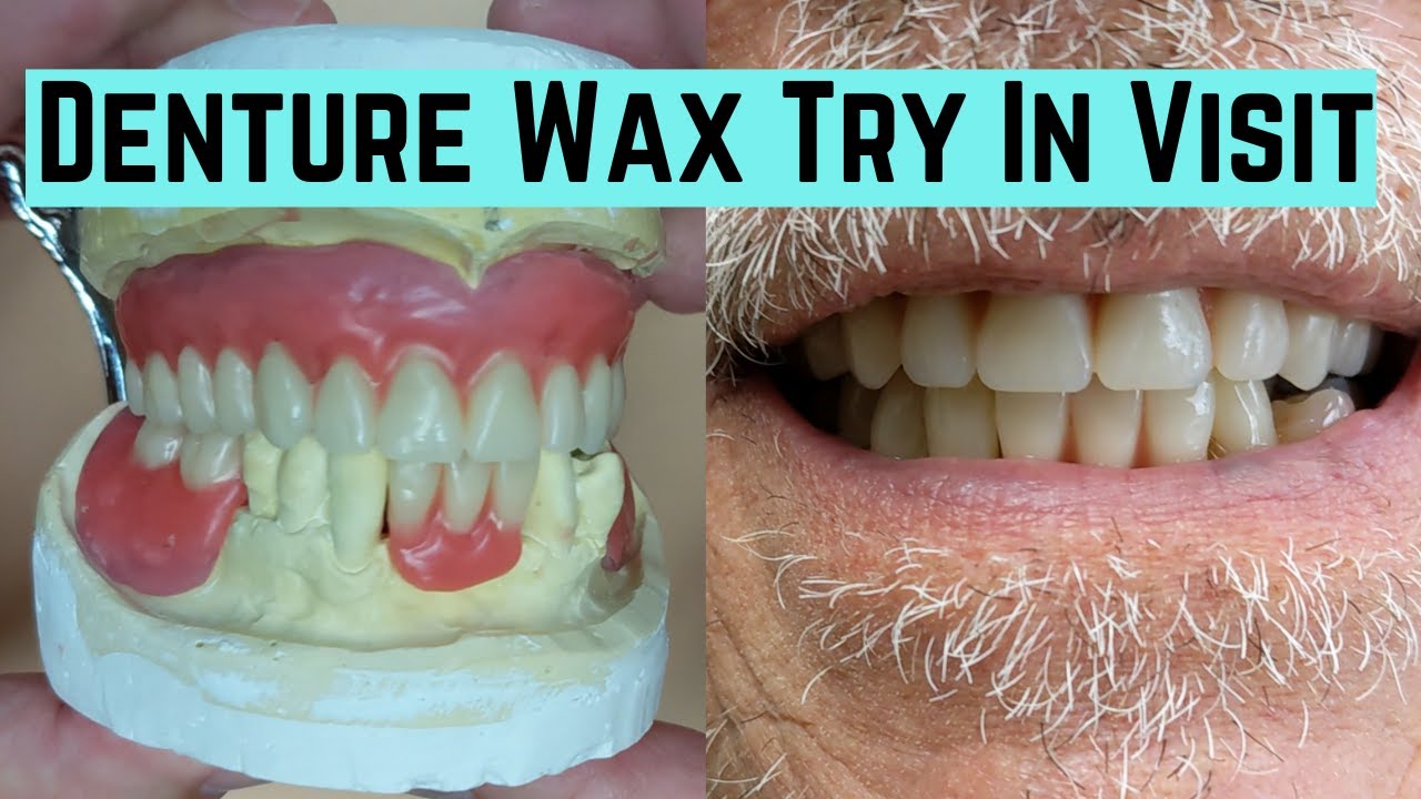Denture Wax Try in visit
