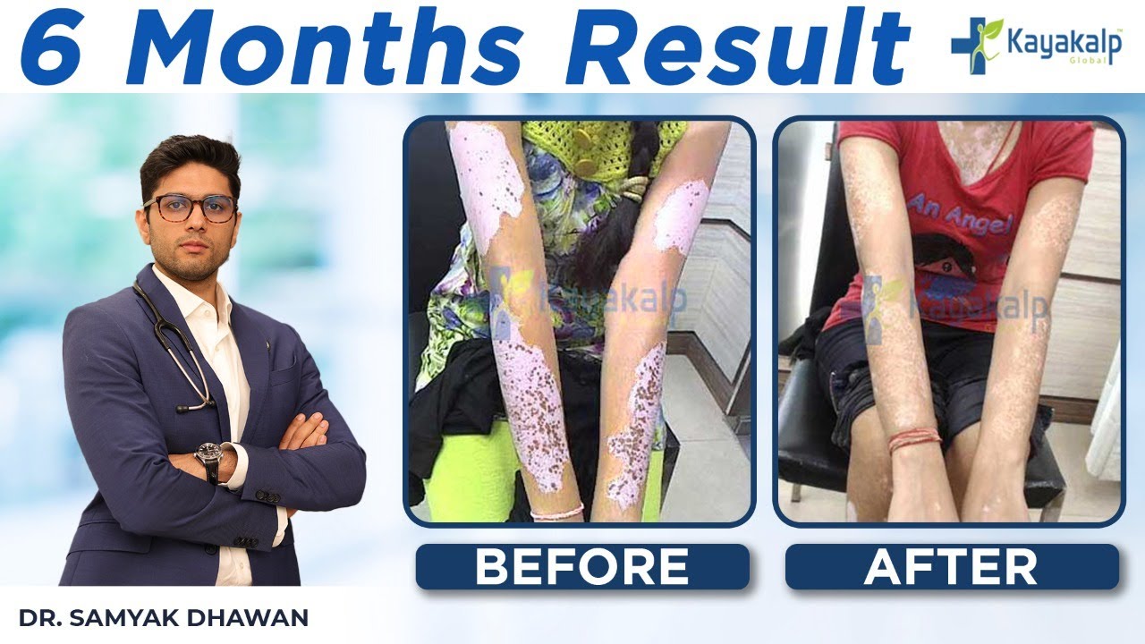 Vitiligo on Hands Treatment in Hindi | हाथों से सफेद दाग/धब्बे कैसे हटाएं?  | Kayakalp Global