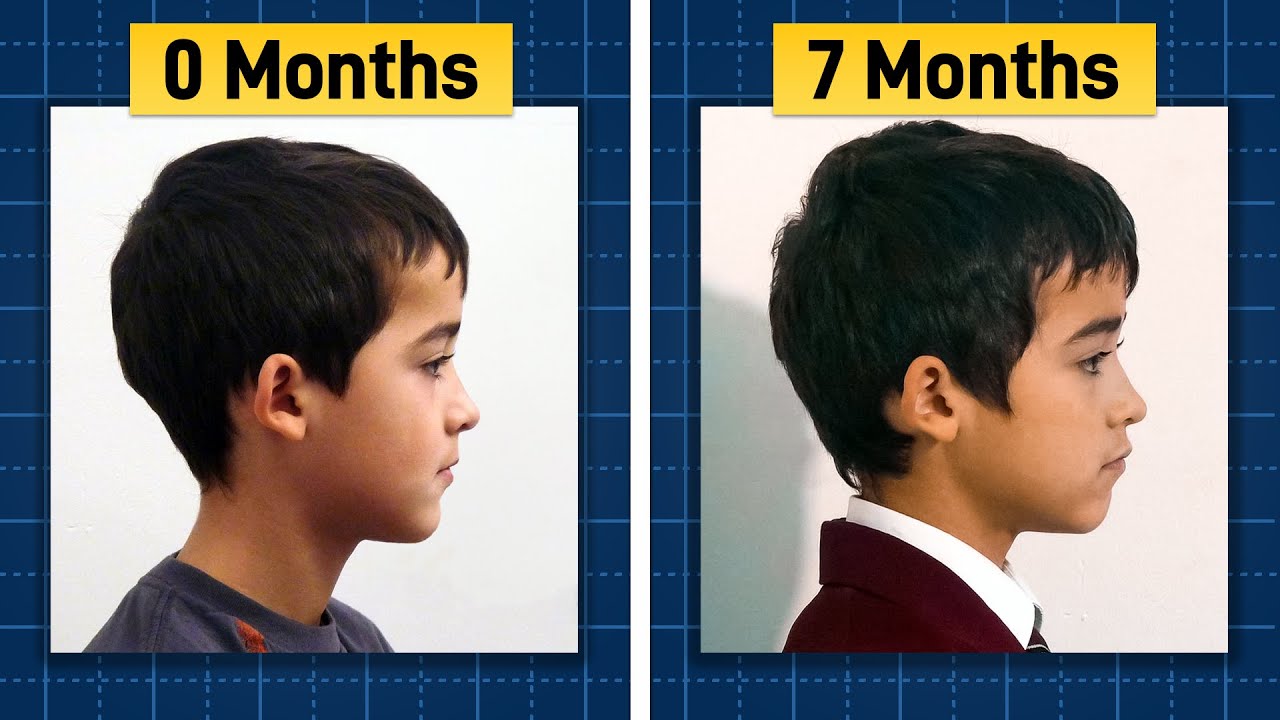 Transforming Nicholas: Overcoming Severe Crossbite Naturally
