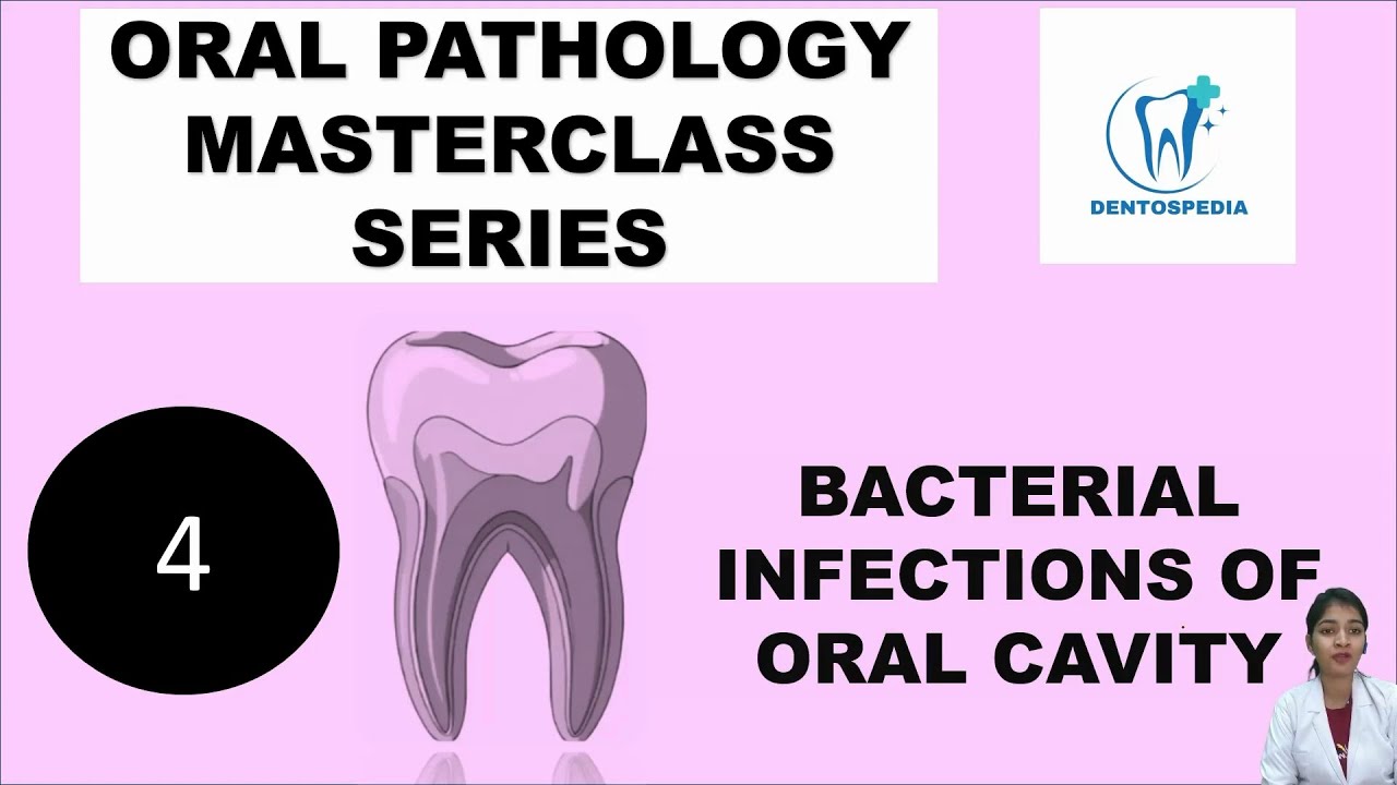 OP 4 Bacterial Infections of Oral Cavity Explained | Oral Pathology #oralpatho #oralpathology #afk