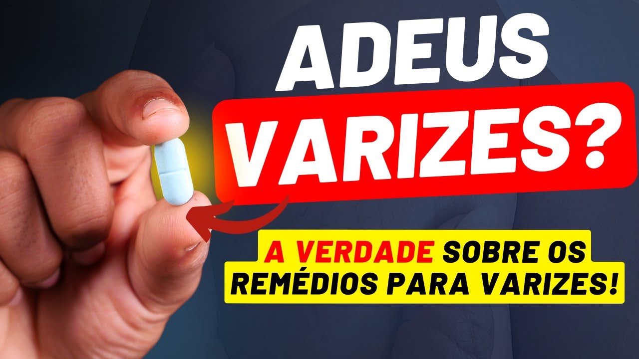Rem&eacute;dio para VARIZES e DORES nas pernas - Existe rem&eacute;dio para eliminar as varizes ?