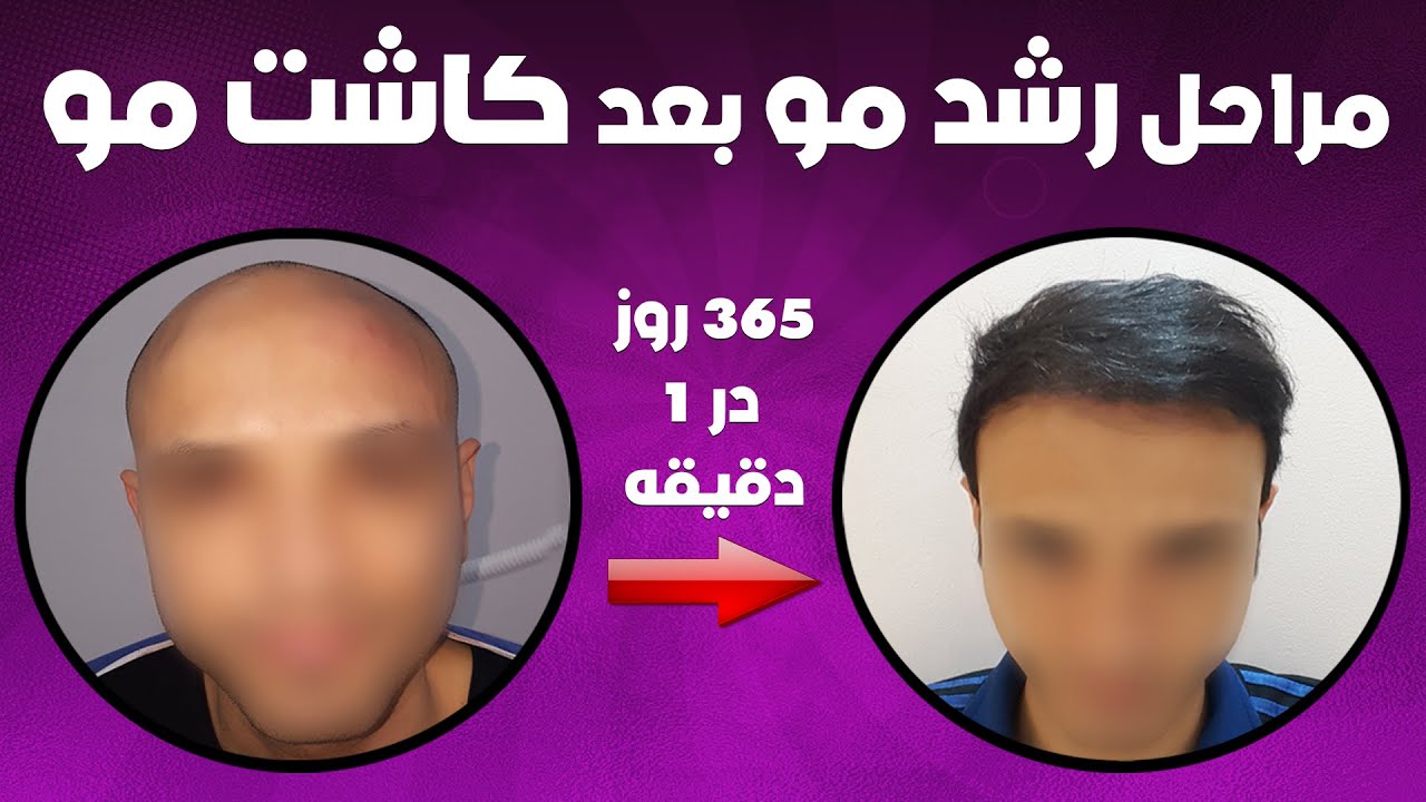 مراحل رشد مو بعد از کاشت مو : 365 وز بعد از کاشت مو در 1 دقیقه