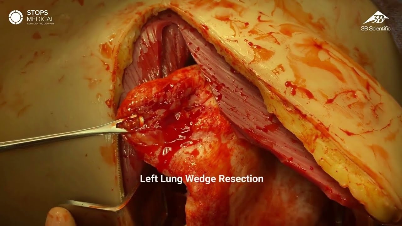 OS3: Left Lung Resection & Resuscitative Left Anterolateral Thoracotomy