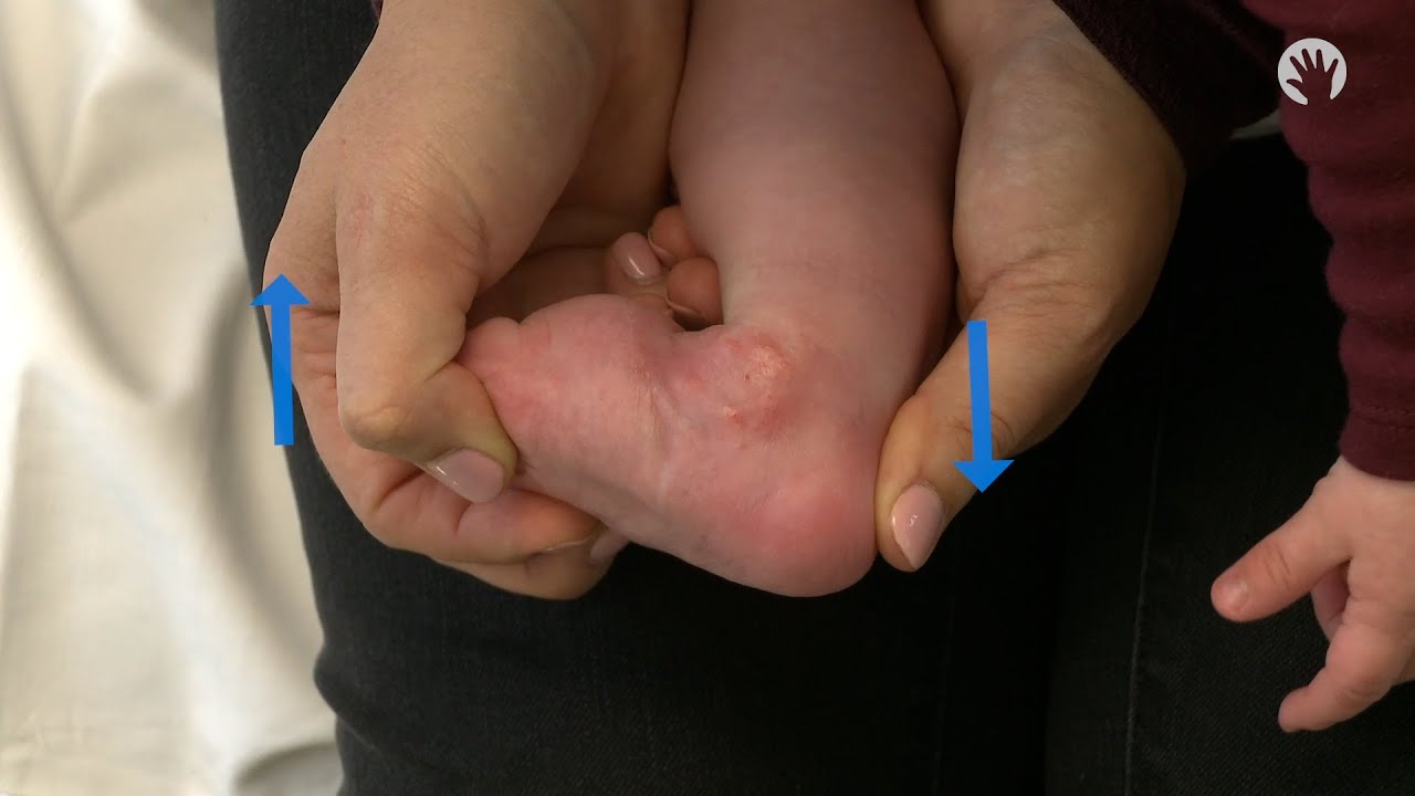 Clubfoot Stretches | Heel Cord Stretch | Module 2