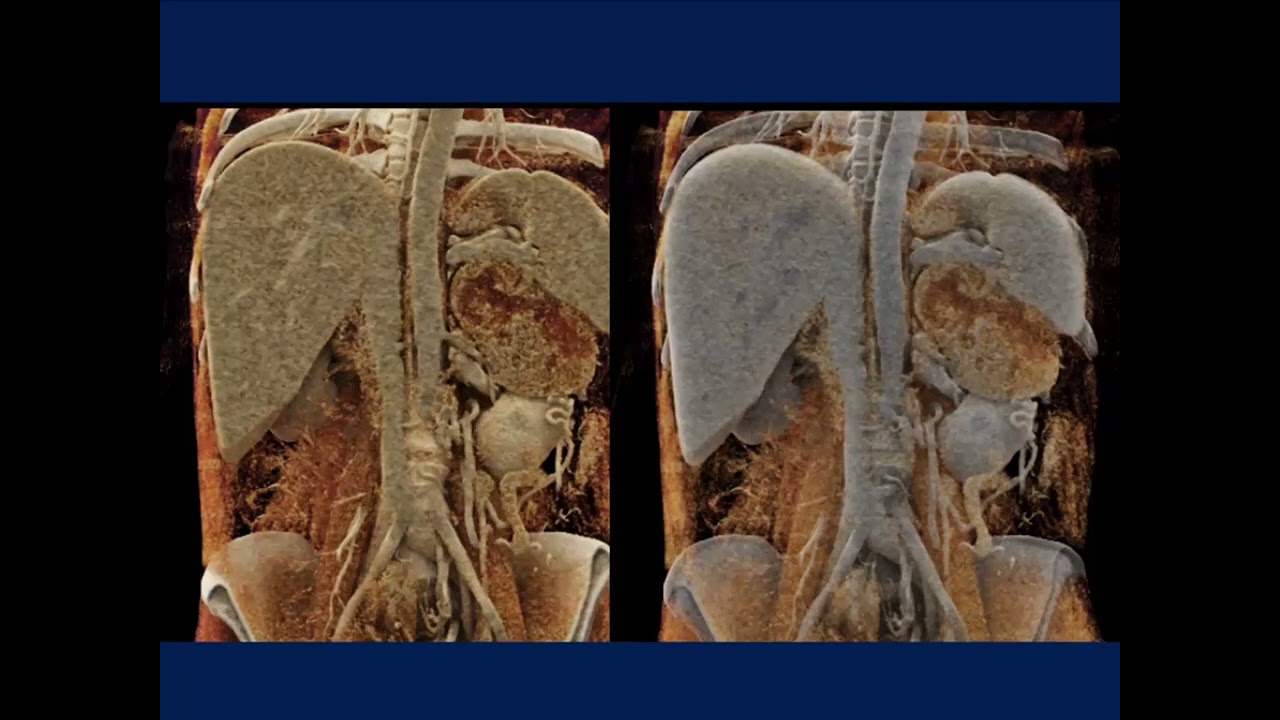 CT of the Adrenal Mass: A Challenging Diagnosis Becomes Even More Difficult - Part 3