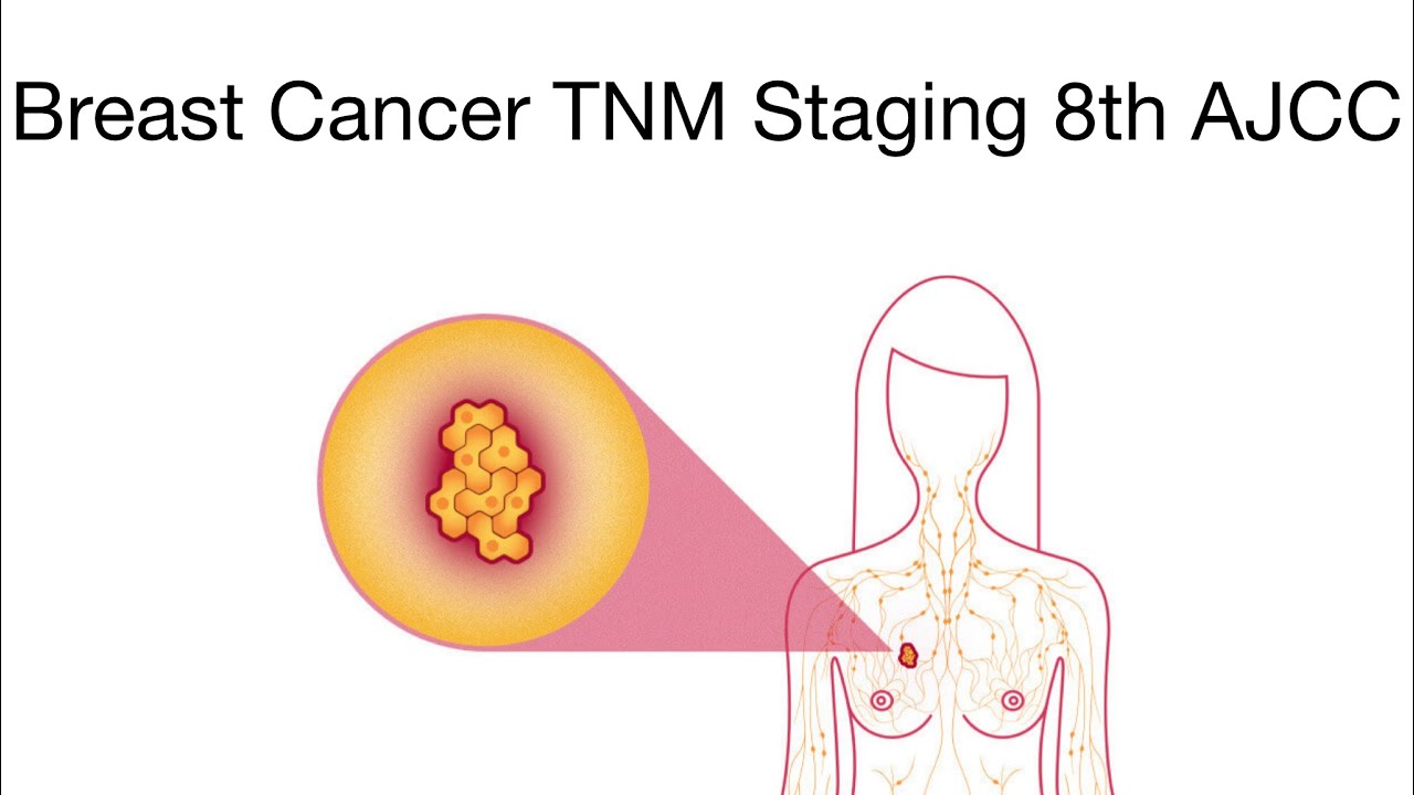 Knowledge Bytes uploaded: Breast TNM 8th AJCC | Simplified🩺