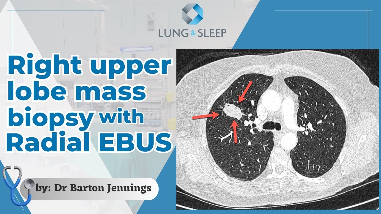 Radial endobronchial ultrasound bronchoscopy to biopsy a lung cancer
