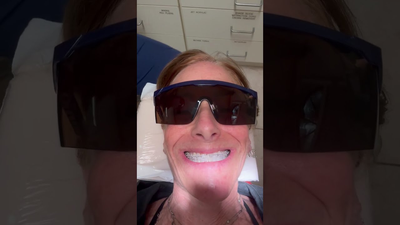 #adultbraces journey. Step 4. #adultdentalcare #adultorthodontics #bocaratonfl