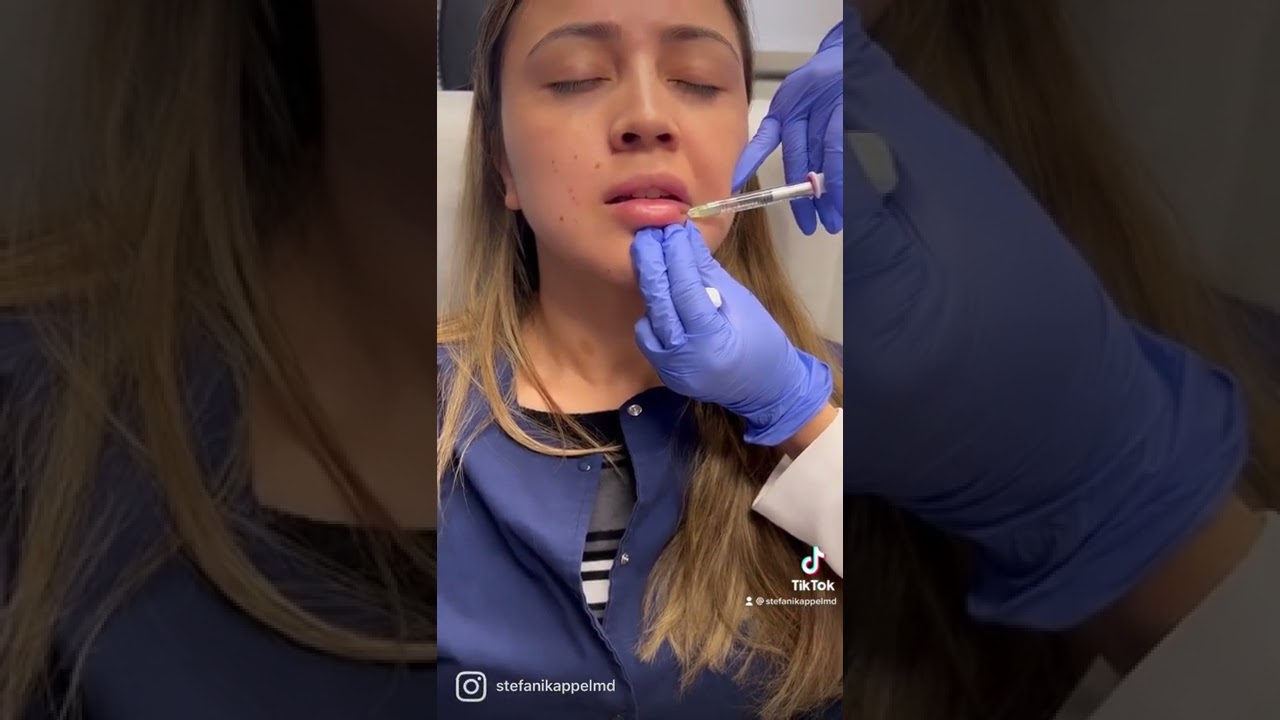 Lip filler with Volbella #lipfiller #shorts