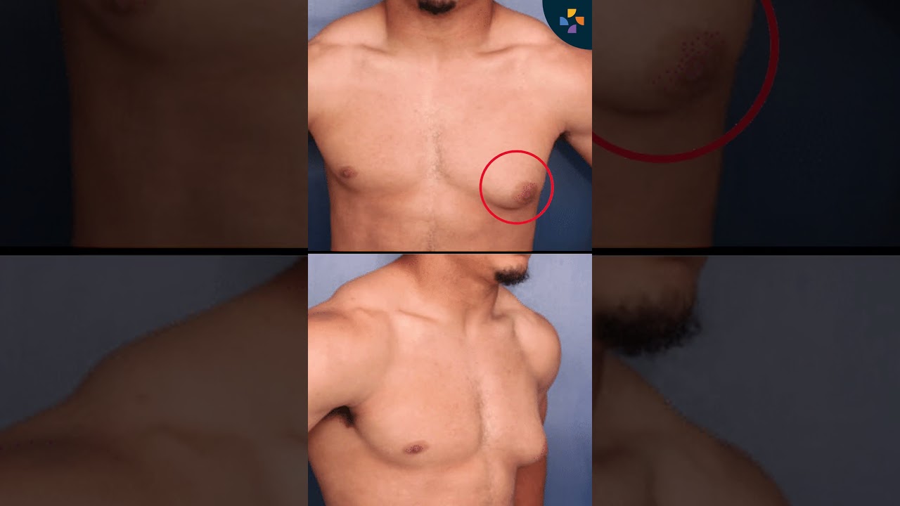 पुरुषों के बड़े स्तन (Gynecomastia) से निजात कैसे पाएं | Say Goodbye to Man Boobs #shorts