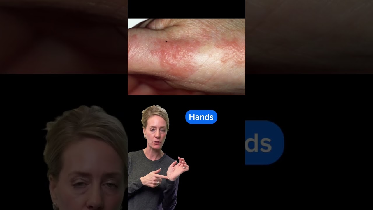 #Eczema doesn&rsquo;t look the same on everyone #atopicdermatitis #eczemaawareness