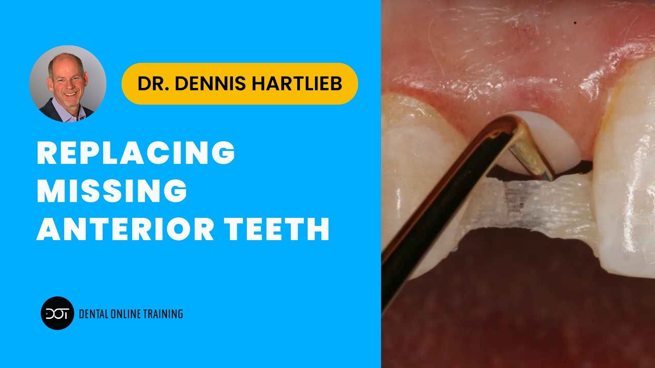 Replacing the Missing Anterior Tooth | Dental Online Training