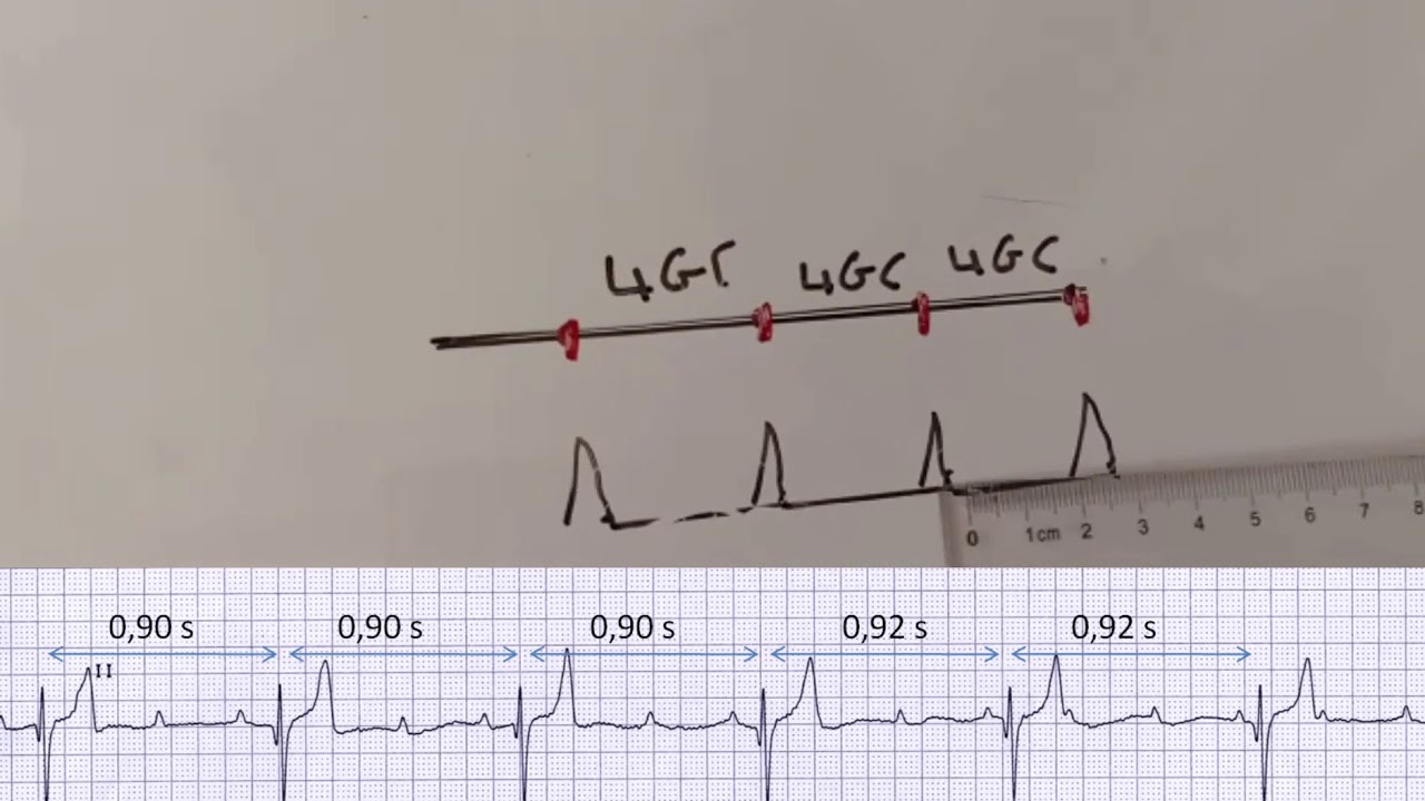 ECG: Interprétation très facile de L'ECG.(6ème partie). Mesure de La Fréquence Cardiaque