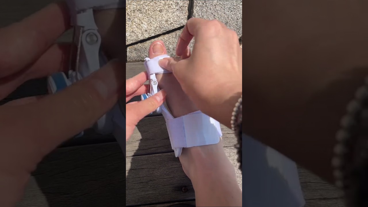 Part 315 halluxvalgus #bigfootbone #footcare#viralvideo#ytshorts