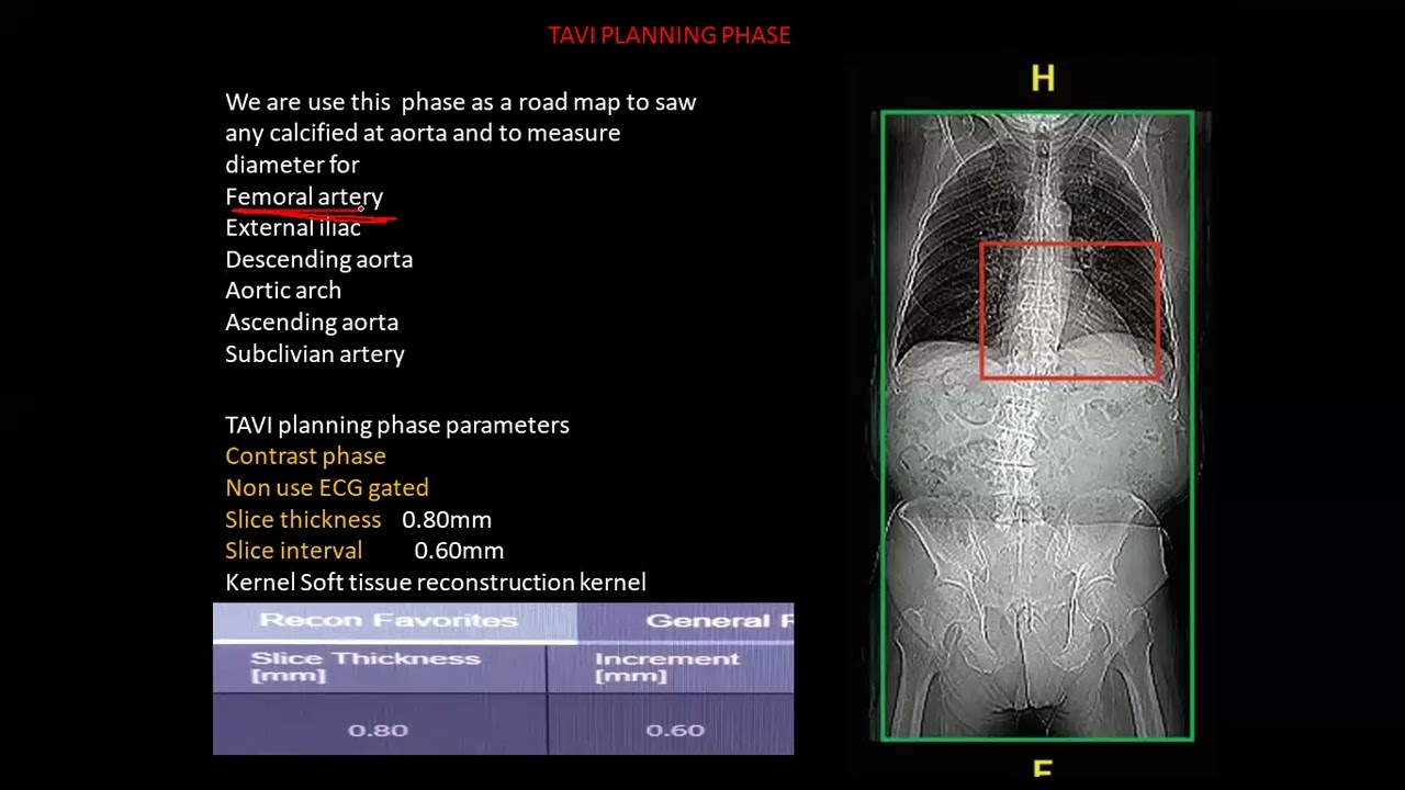 Part 4 TAVI protocol CT final 