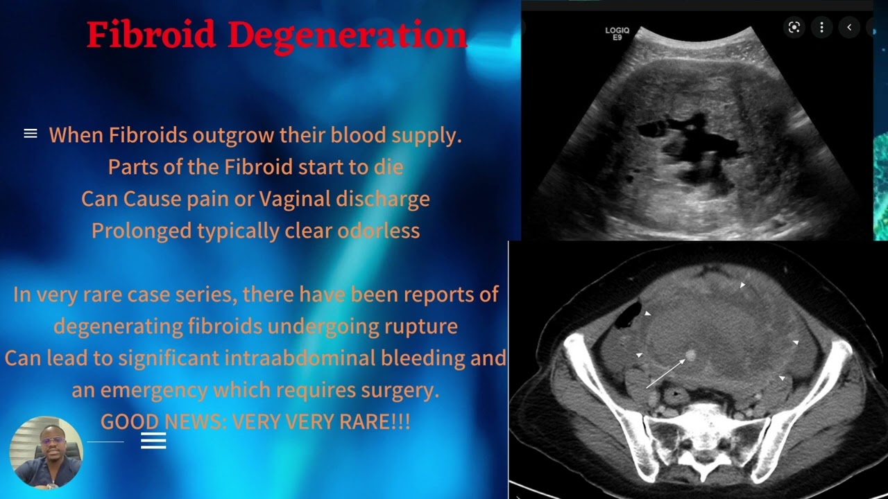 Can fibroids rupture? What is Fibroid Degeneration?