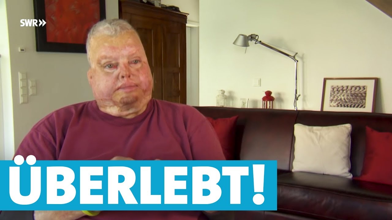 Bernhard überlebt Flugzeug-Explosion trotz schwerer Verbrennungen