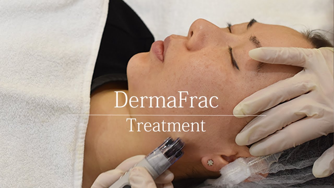 DermaFrac - treatment video