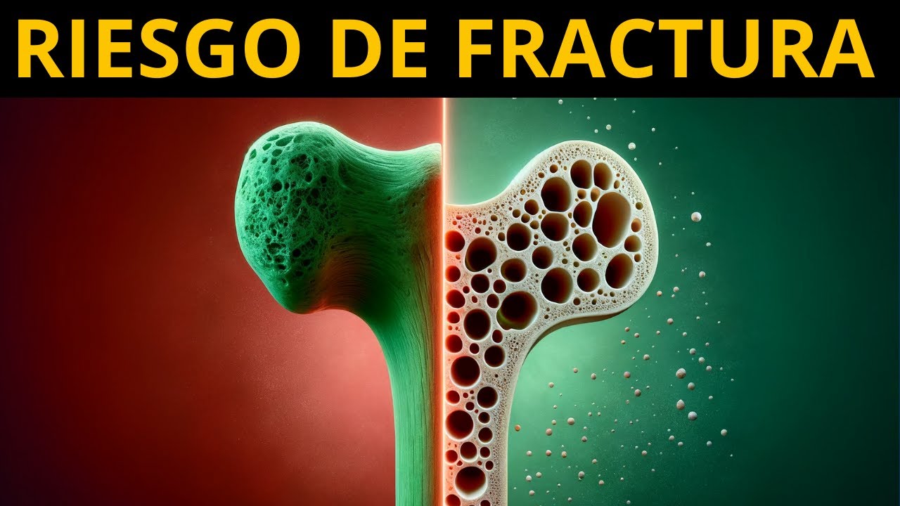 REDUCE TU RIESGO DE FRACTURAS - Osteoporosis y osteopenia