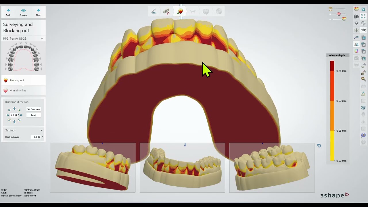 how to trim a scan for splint studio