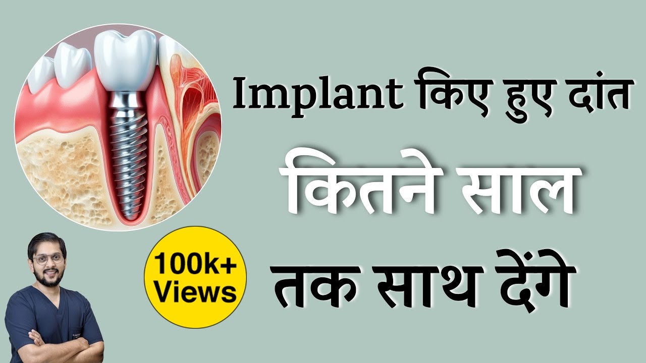 Life of Dental Implants How Many Years |  डेंटल इम्प्लांट की लाइफ | Successful dental implant Indore