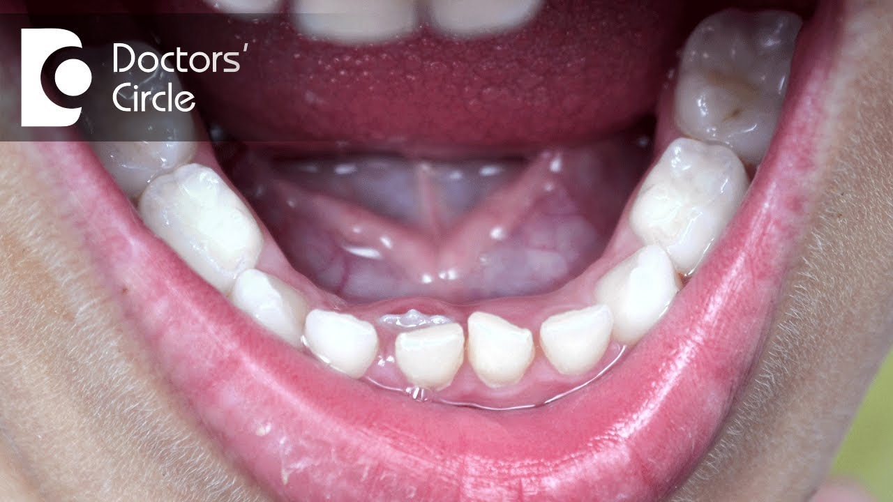 What should one do if adult permanent tooth is coming behind milk teeth? - Dr. Raju Srinivas