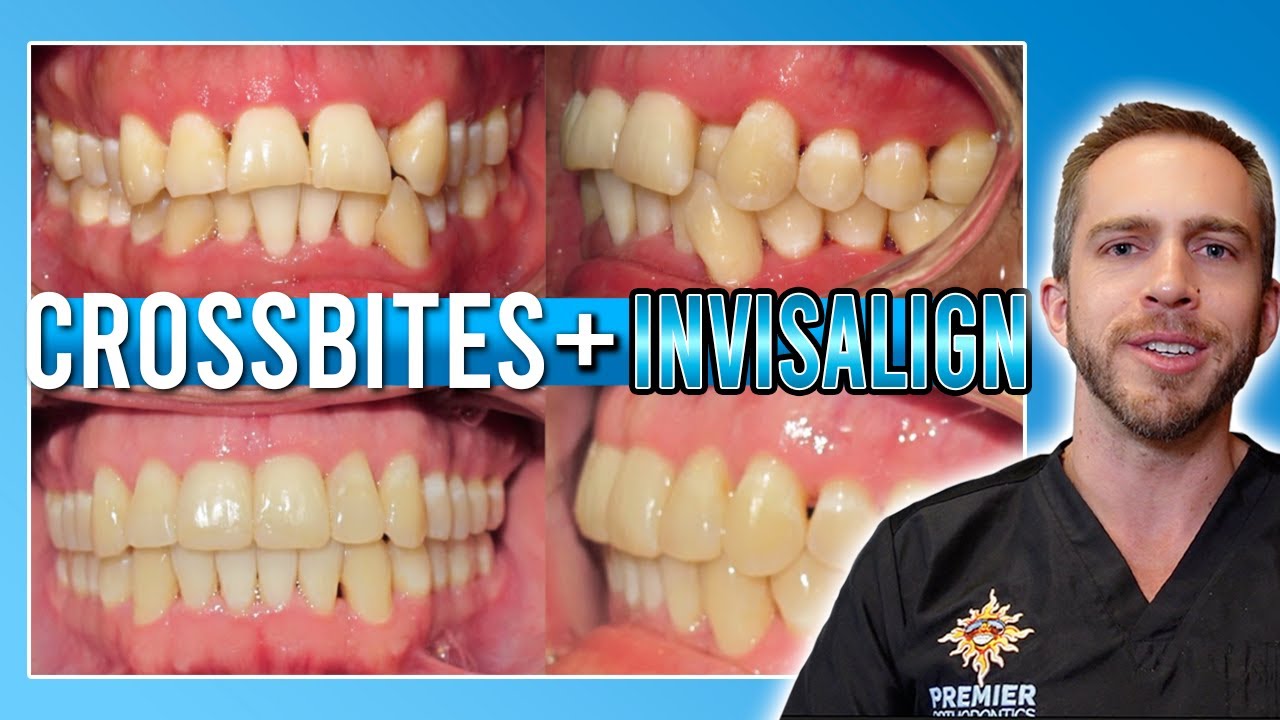 Invisalign Crossbite Treatment! [BEFORE & AFTER]