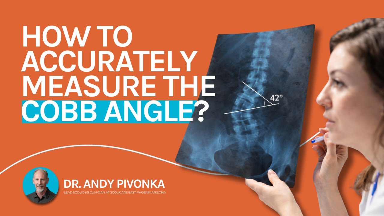 How to Measure Cobb Angle Correctly (Step-by-Step Guide for Scoliosis Assessment)