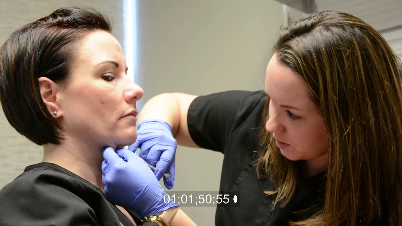 What Does Kybella Injection Look Like?