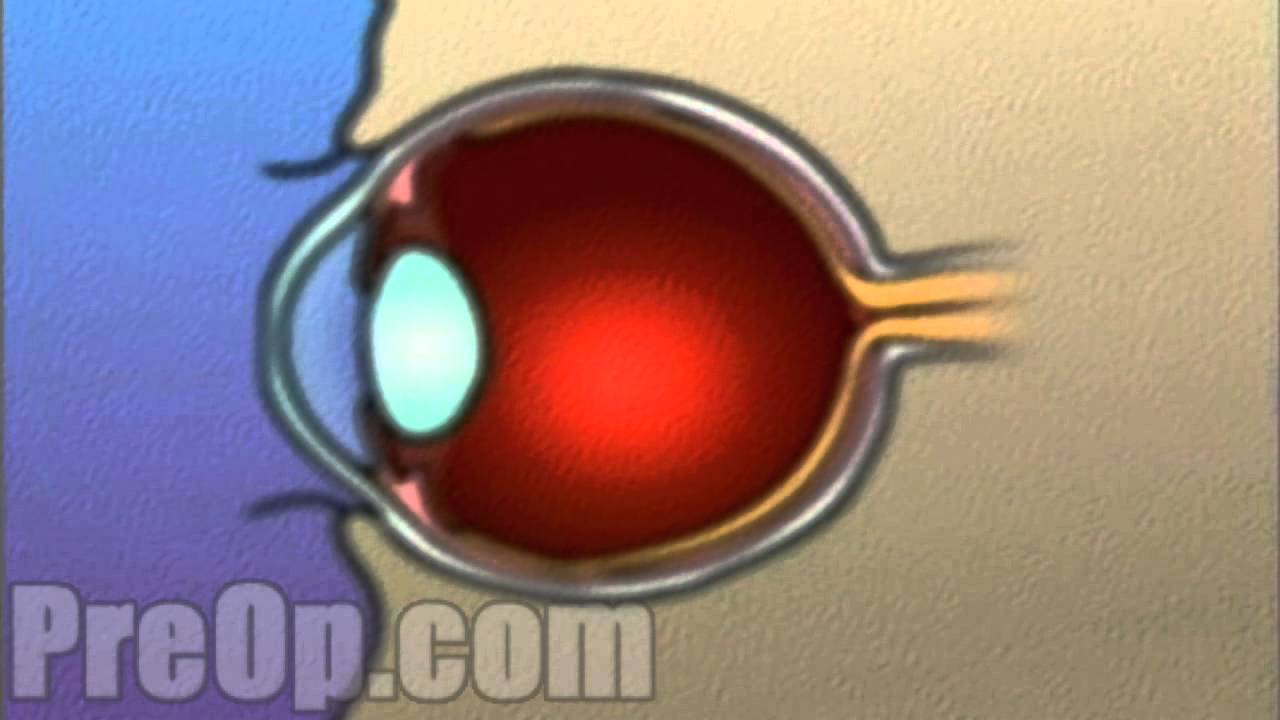 Laser Eye Surgery PRK PreOp® Patient Engagement and Education